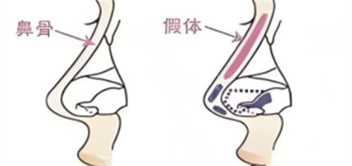 房志强医生的鼻综合手术真的靠谱吗？我的肋骨鼻经历告诉你：术后结果自然又精致​