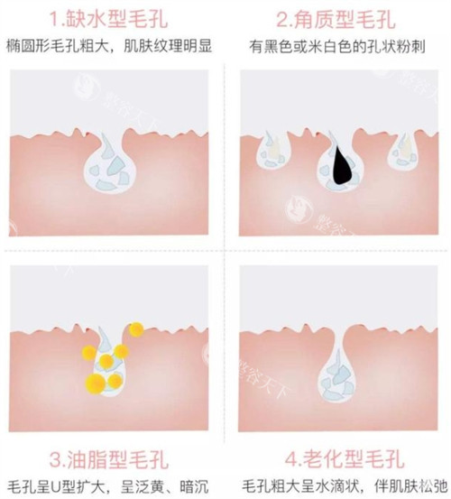 收缩毛孔做什么医美项目比较好？黄金微针、光子嫩肤、点阵激光等都不错