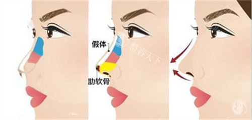 房志强医生的鼻综合手术真的靠谱吗？我的肋骨鼻经历告诉你：术后结果自然又精致​