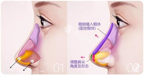 房志强医生的鼻综合手术真的靠谱吗？我的肋骨鼻经历告诉你：术后结果自然又精致​