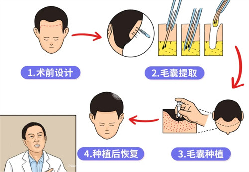 成都大麦微针植发技术怎么样？可靠医疗团队量身定制植发方案，结果自然持久