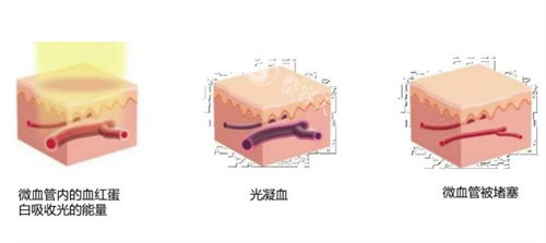 造成红血丝的几种原因 造成红血丝的几种原因