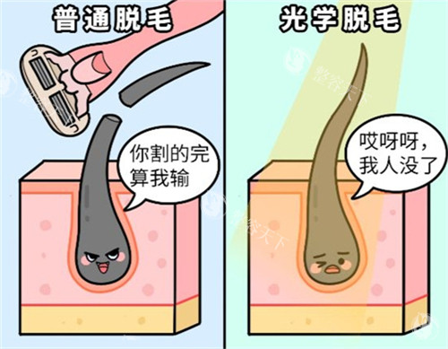 激光脱毛和普通刮毛的区别 激光脱毛和普通刮毛的区别