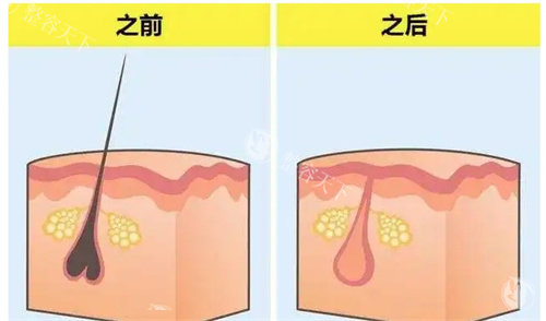 脱毛前后的毛囊 脱毛前后的毛囊
