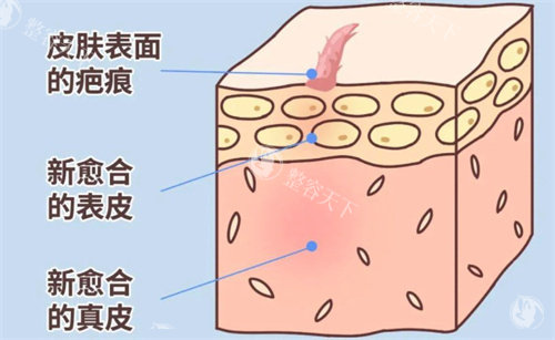 疤痕的形成过程 疤痕的形成过程