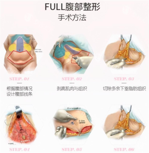 腹壁成形术手术过程图解 腹壁成形术手术过程图解