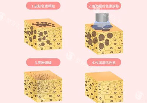 CO2激光治疗仪原理全解析：从疤痕修复到皮肤年轻化应用！