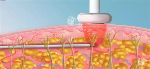 CO2激光治疗仪原理全解析：从疤痕修复到皮肤年轻化应用！