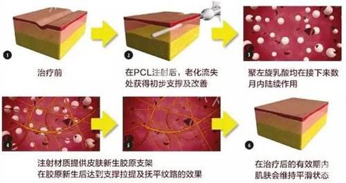 爱塑美童颜针注射前后变化图解 爱塑美童颜针注射前后变化图解