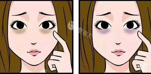 纠结！美诗沁和健丽去眼袋哪个好？看完技术与口碑再定