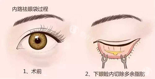 亲身体验：广州健丽美诗沁医疗美容去眼袋到底怎么样？技术成果与口碑说话