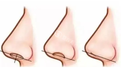 深圳王杰隆鼻口碑怎么样？从爱美者的口碑中来看是一位口碑比较好的医生！