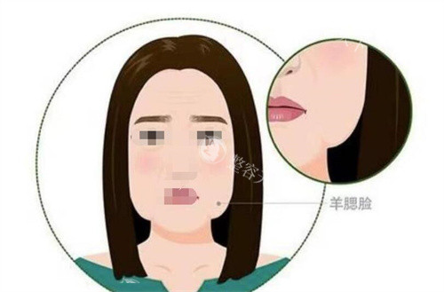 爱尔菲琳溶脂是械三吗? 爱尔菲琳溶脂是械三吗?