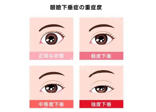 上睑下垂矫正手术价格一览表：内部报价4800元起,术后睁眼有神,告别无神“瞌睡眼”!
