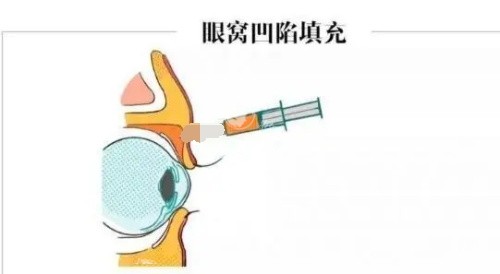 眼窝凹陷填充 眼窝凹陷填充