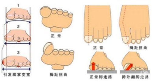 上海虹桥医院拇外翻技术咋样？小创口、医生经验、患者口碑多角度解析