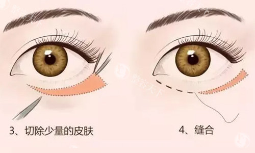 郑州健丽医美是正规医院吗？是正规的去眼袋专科医美整形 ！
