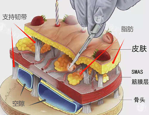 升无痕筋膜提升手术医院哪家好? 升无痕筋膜提升手术医院哪家好?