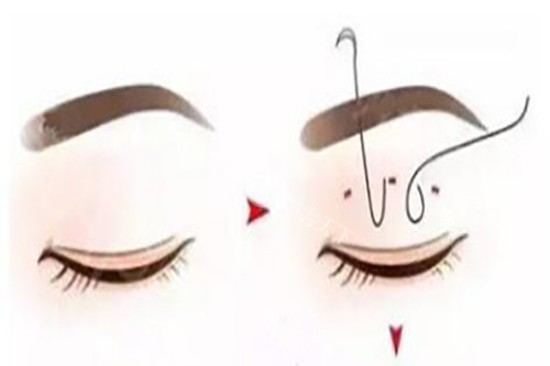 鹿世江双眼皮做得如何? 鹿世江双眼皮做得如何?