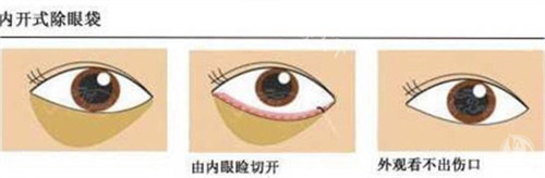 郑州健丽医美是正规医院吗？是正规的去眼袋专科医美整形 ！