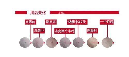 激光祛痣价格一览表：50元起/颗,安心不痛,不留痕迹!