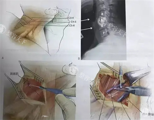 下颌缘提升和颈阔肌放松是一回事吗？不是，揭晓下颌缘提升和颈阔肌放松的区别