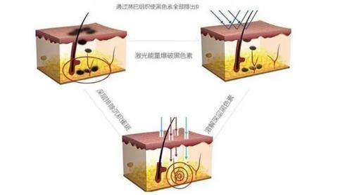 激光祛痣价格一览表：50元起/颗,安心不痛,不留痕迹!