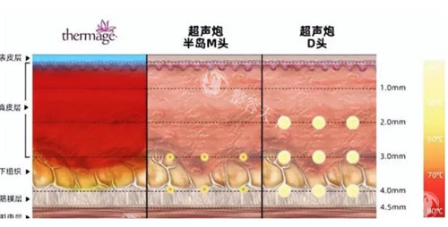 超声提拉价格一览表：12800元起,SMAS层提拉,减龄结果超惊艳!
