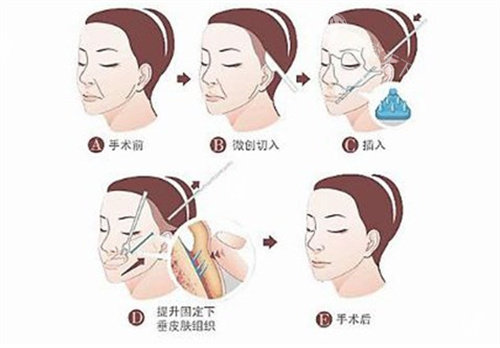 合肥做筋膜提升哪个医生好?刘冷/崔劲松/赵辑/卫爱侠/甘泉涌都是做筋膜提升技术好的医生