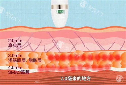 超声提拉价格一览表：12800元起,SMAS层提拉,减龄结果超惊艳!