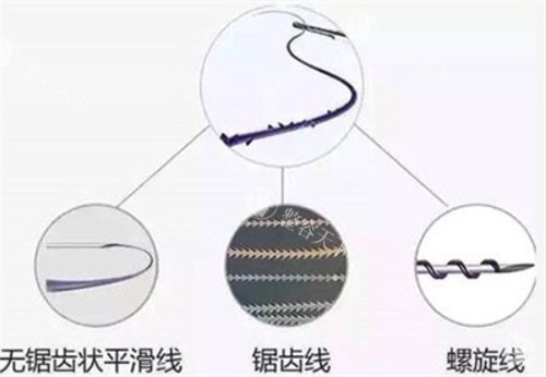 埋线提升价格一览表:不同材质线材收费标准在6800-1.98W元起,附实例全程记录!