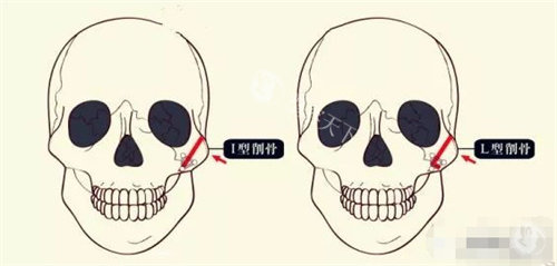 颧骨整形图片 颧骨整形图片