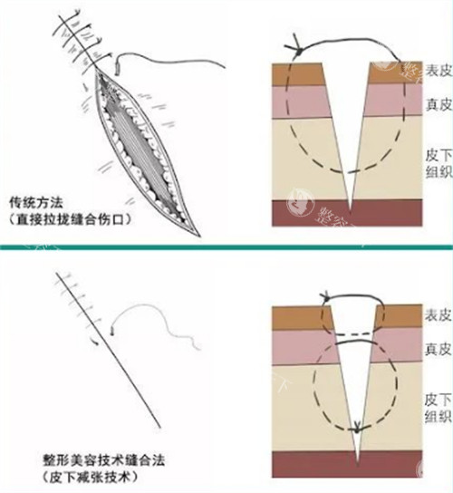 苏州乐桥疤痕专科怎么样?从仪器到医生,深度解析祛疤硬实力
