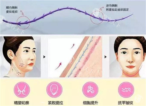 面部埋线材料有哪几种类型？PDO线、PPDO线、PLLA线等5大类线材特性及适用部位详解