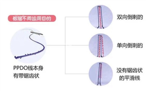 面部埋线材料有哪几种类型？PDO线、PPDO线、PLLA线等5大类线材特性及适用部位详解