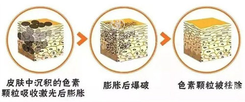 超皮秒祛斑会反弹吗?一般做好皮肤护理不会反弹|主要是利用超短脉冲的激光击碎黑色素