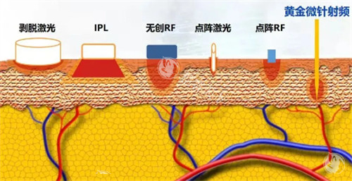 半岛黄金射频功效和作用是什么？可紧致肌肤、淡化皱纹、改善肤质以及祛痘祛疤印