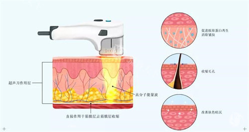 超声炮副作用预警！术后一年皮肤加速老化怎么办？