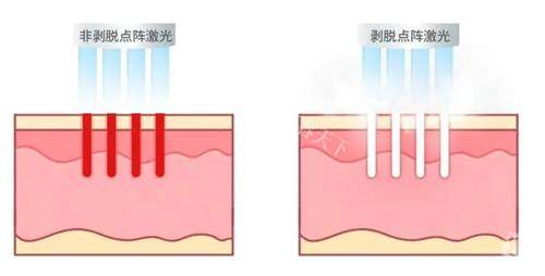 苏州点阵激光哪家医院结果好？价格、设备、医生技术大PK，痘痘肌必看！