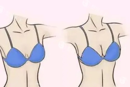 武汉假体隆胸选哪位医生好？技术、口碑、价格多方位对比，看完再决定！