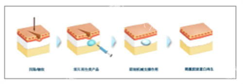 双矢量提升术VS微拉美到底哪个好？专科对比分析帮你找到更适合的抗衰方案！