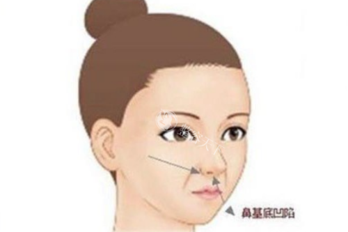 福州朱刚强医生鼻子怎么样？精细化鼻尖鼻梁整形+小创口鼻翼缩小，15年鼻整形大师实例解析