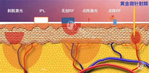 苏州点阵激光哪家医院结果好？价格、设备、医生技术大PK，痘痘肌必看！