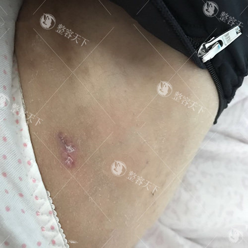 花 2.5 万做大腿抽脂值吗？亲身经历告诉你：这 5 类人更适合射频溶脂！