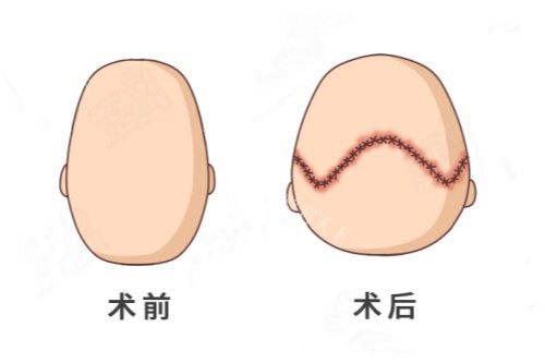 国内后脑勺填充手术哪家强？盘点各大城市靠谱医院，帮你解决扁平头困扰！