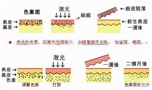 痘印细纹怎么改善？韩国医院超全攻略分享，从激光到护理一站式解决皮肤问题！
