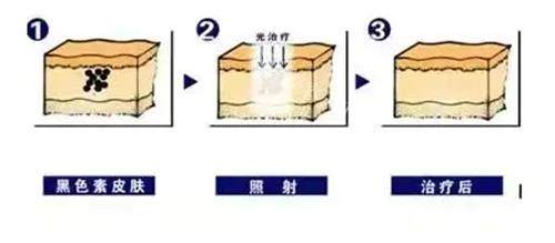 痘印细纹怎么改善？韩国医院超全攻略分享，从激光到护理一站式解决皮肤问题！