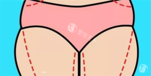 杭州彭涛吸脂怎么样​？个性化的方案设计、术中精细娴熟的操作手法、术后显著的塑形结果