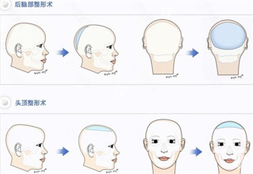 国内后脑勺填充手术哪家强？盘点各大城市靠谱医院，帮你解决扁平头困扰！