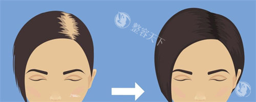 公布啦2025武汉植发手术价位表：发际线种植3280+微针植发5888+不剃发植发6999+